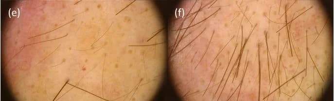 Clinical photographs of a 44-year-old man's bald scalp after five months of vorasidenib treatment