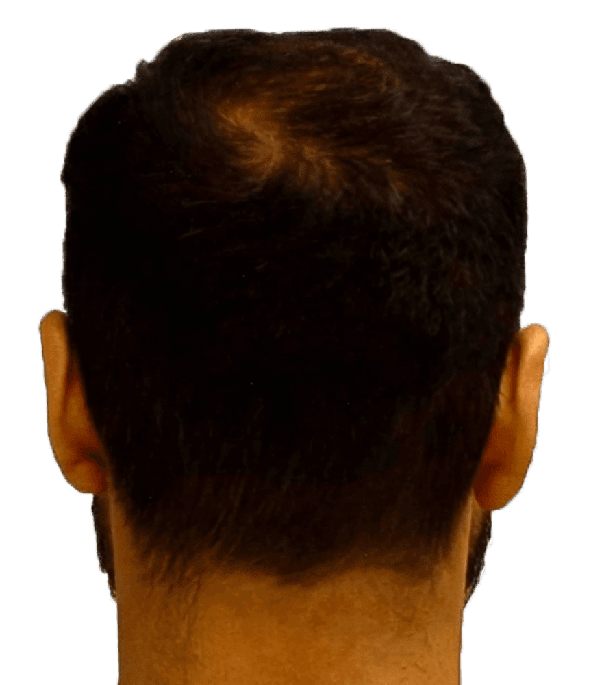 After treatment